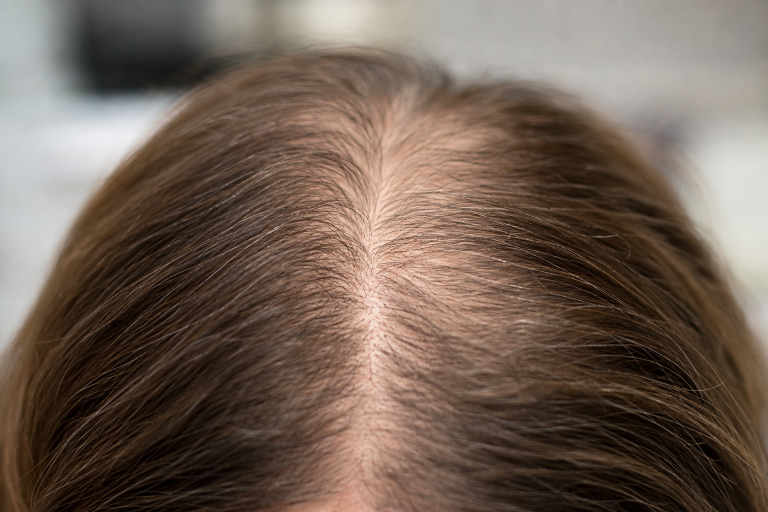 Menopause And Hair Thinning: Causes, Practical Care, And When To See A Doctor